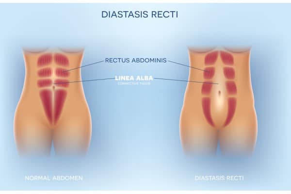 How Does Non-Surgical Treatment Help With Loose Skin, Weak Abdominal Muscles and Post-Pregnancy Changes Wolverhampton?