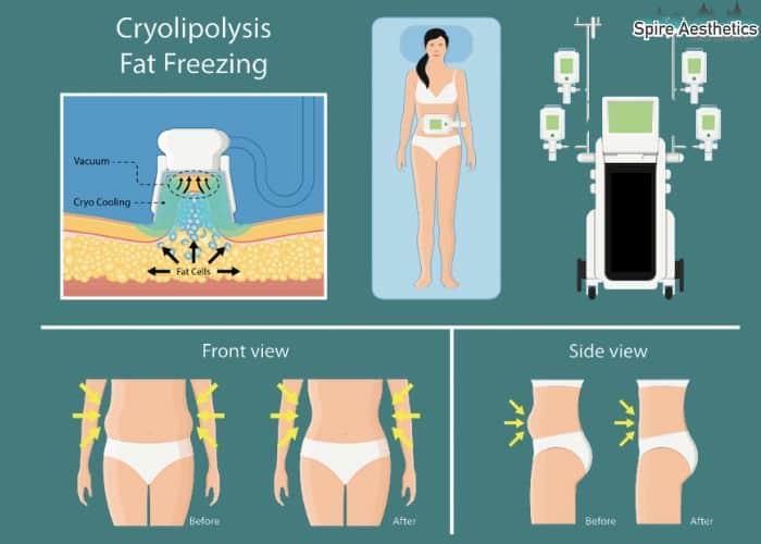 Image of diet and fat freezing combined for best results for Spire Aesthetics Wolverhampton