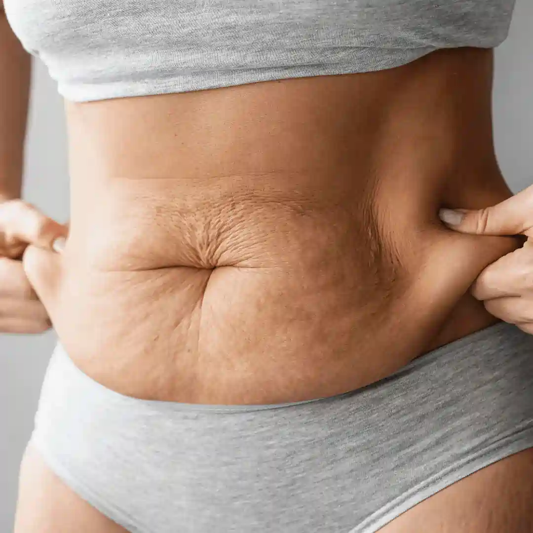 Is It Normal to Have Loose Skin After Pregnancy Wolverhampton?