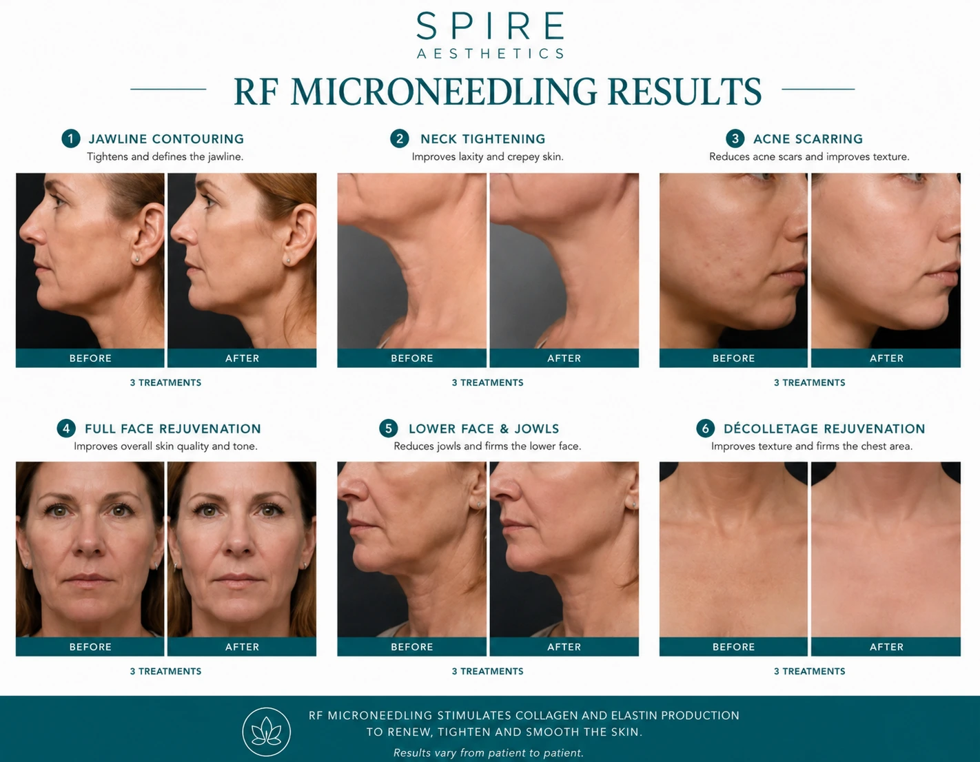 RF Microneedling Skin tightening Wolverhampton results