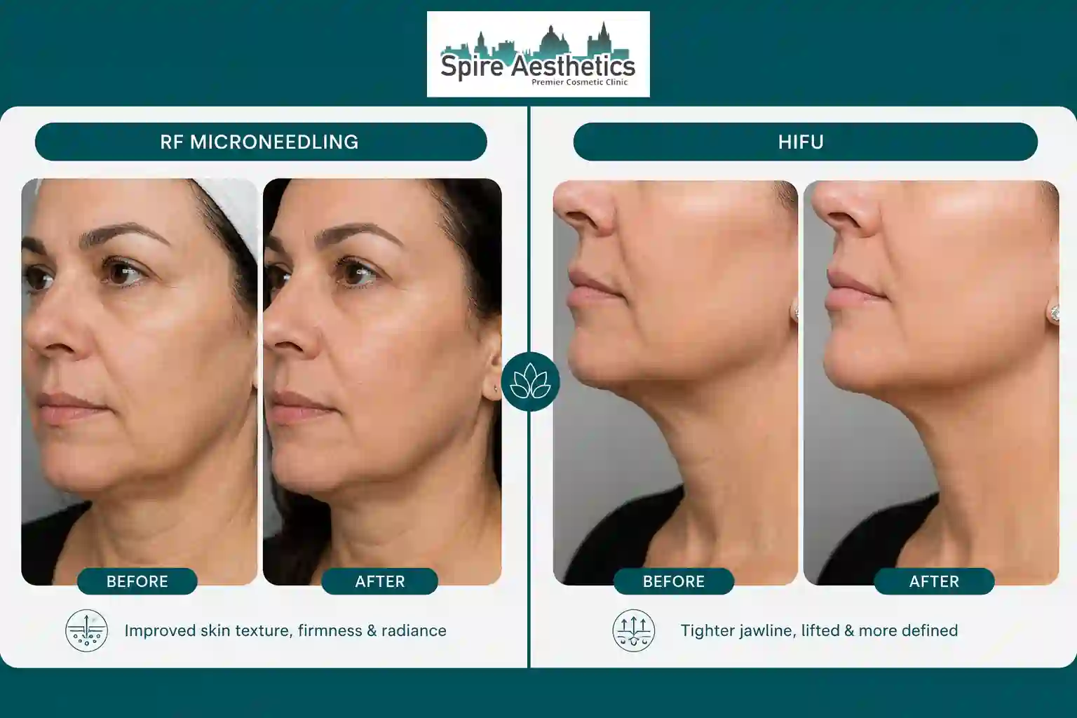 Can RF Microneedling and HIFU Be Combined Wolverhampton?