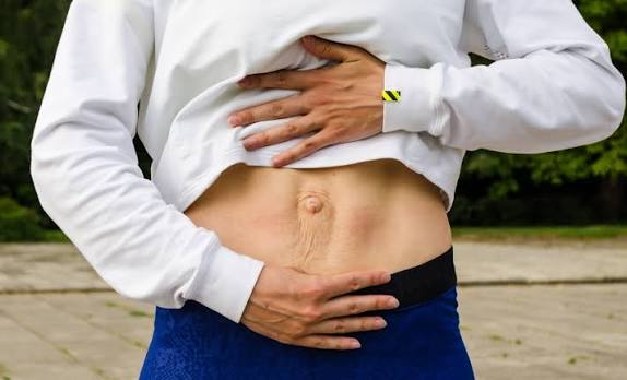 When Could Diastasis Recti Be the Missing Piece of the Puzzle Wolverhampton?