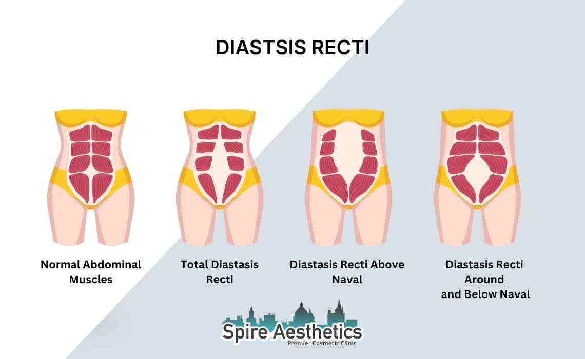 Is Non-Surgical Diastasis Recti Treatment Right for You? Common Concerns Answered Wolverhampton